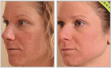 Halo™ Laser Treatment for Rochester & Brighton, NY | Dermatology ...