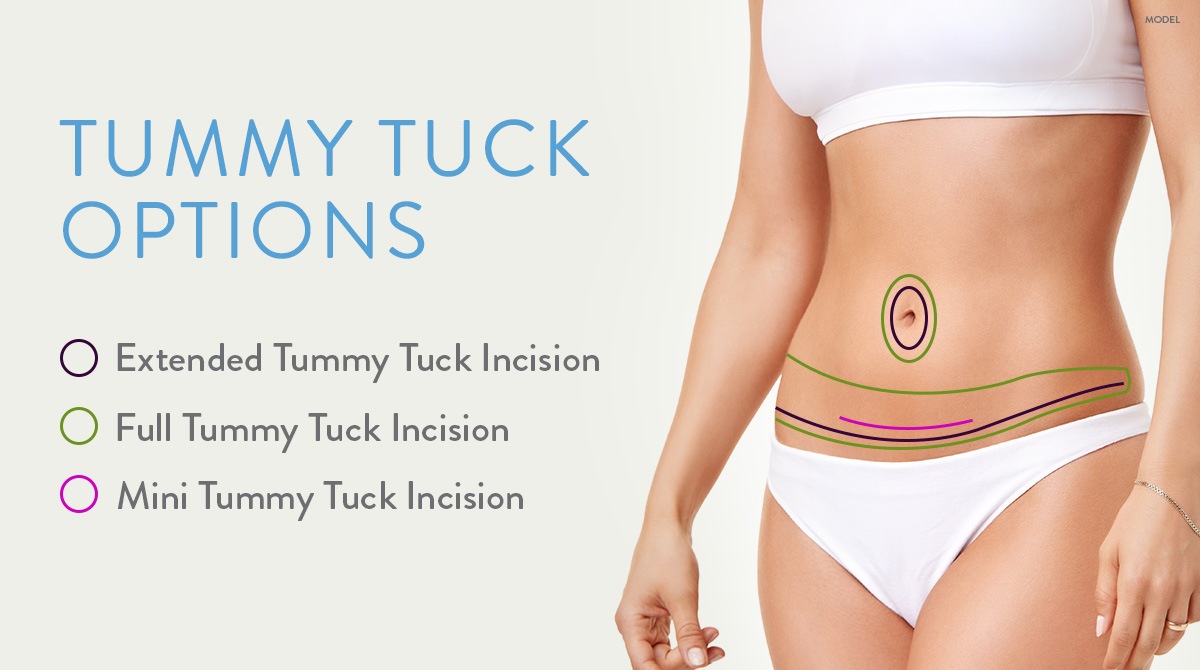 Mini Tummy Tuck Vs Full Tummy Tuck Choosing The Right Procedure Dermatology Associates Of 