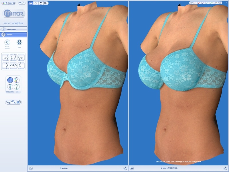 VECTRA® 3-D Imaging for Plastic Surgery in Rochester, NY