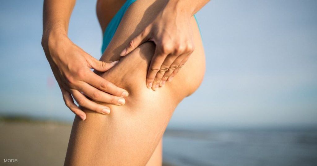 How To Get Rid of Cellulite in 2024: 14 Tips from Dermatologists