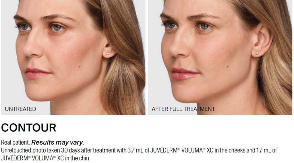 Image of a woman before and after her full JUVEDERM treatment in the cheeks and chin. Photo courtesy of Allergan Aesthetics
