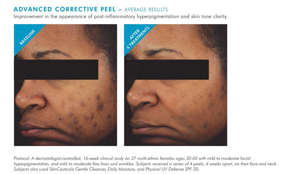 Oblique view of patient’s face before and after 4 advanced corrective peels. After photo shows less hyperpigmentation.
