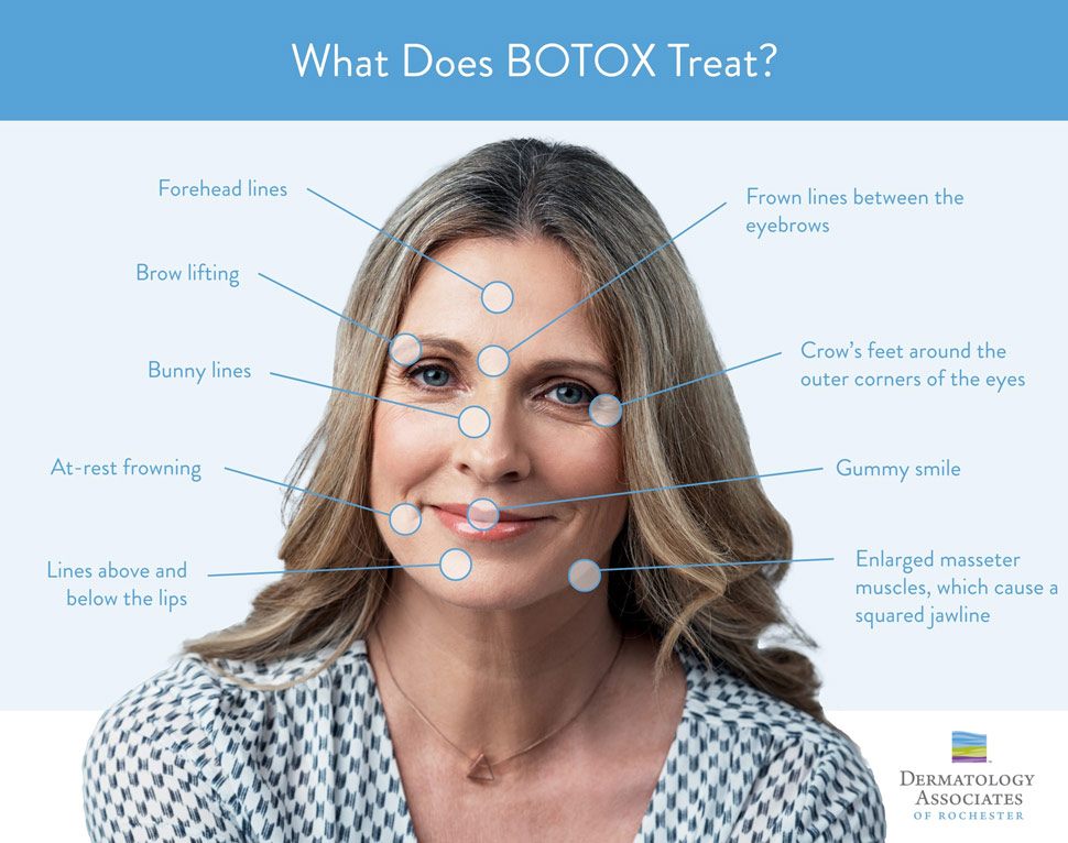 What does Botox Treat: Forehead lines, Brow lifting, Bunny lines, At-rest frowning, Lines above and below the lips, Frown lines between the eyebrows, Crow's feet around the outer corners of the eyes, Gummy smile, Enlarged masseter muscles which cause a squared jawline