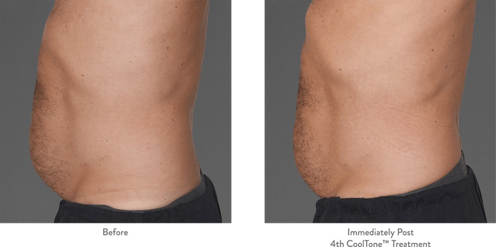 Side view of man’s abdomen before and after Cooltone. The after photo shows a flatter, less rounded belly.