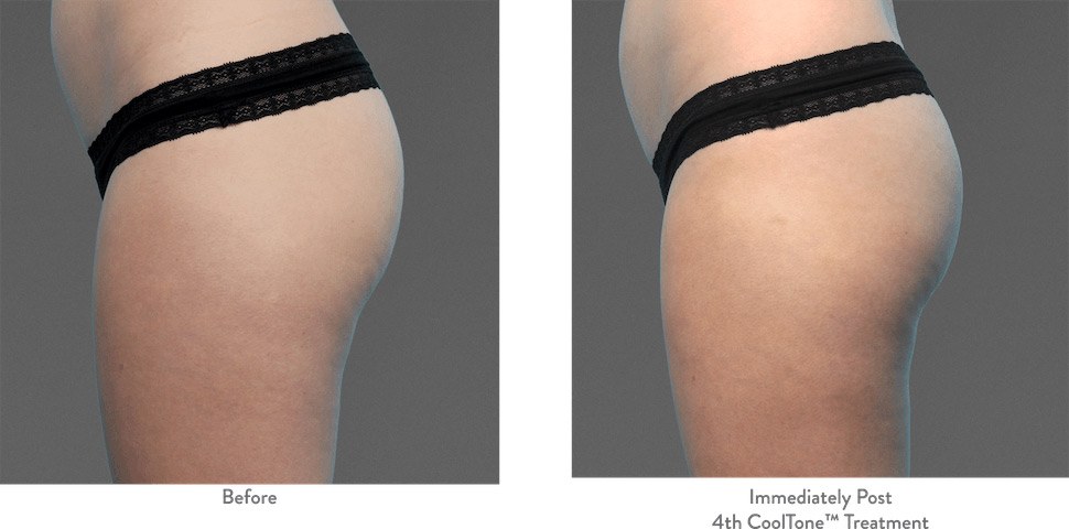 Side view of buttocks and upper thighs before and after CoolTone, showing more definition between butt cheek and thigh.