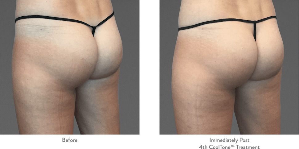 Buttock and upper thigh views before and after CoolTone, showing tighter and rounder buttocks after treatment.