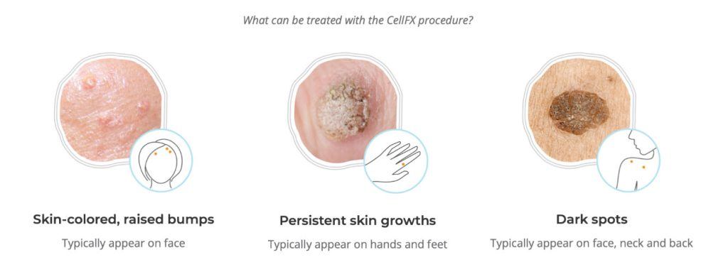 What can be treated with the CellFX procedure? Skin colored, raised bumps, persistent skin growths, dark spots.